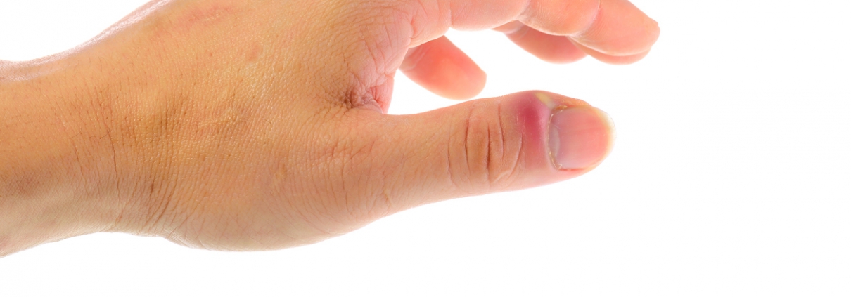 What Is an Ingrown Nail and How Should It Be Treated? - GoodRx